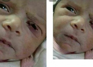 رد قصور پزشکی در حادثه پارگی پلک نوزاد نطنزی