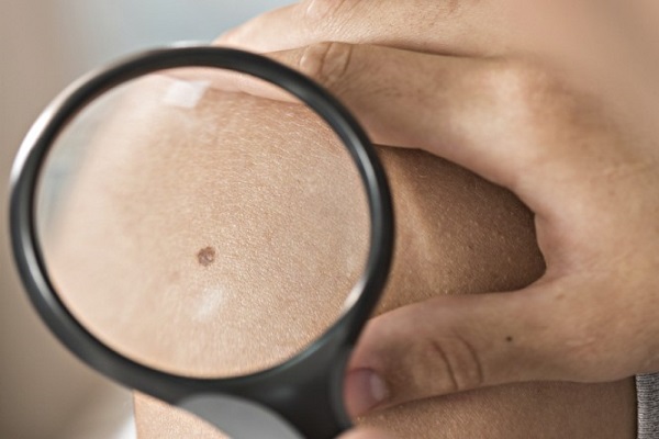 نشانه‌های خال سرطاني