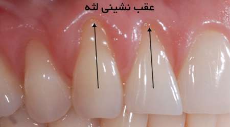 تحلیل یا عقب نشینی لثه را جدی بگیرید