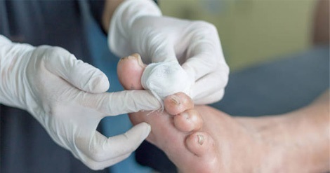 درمان ۱۲۰ بیمار زخم دیابتی به روش پلاسما در البرز