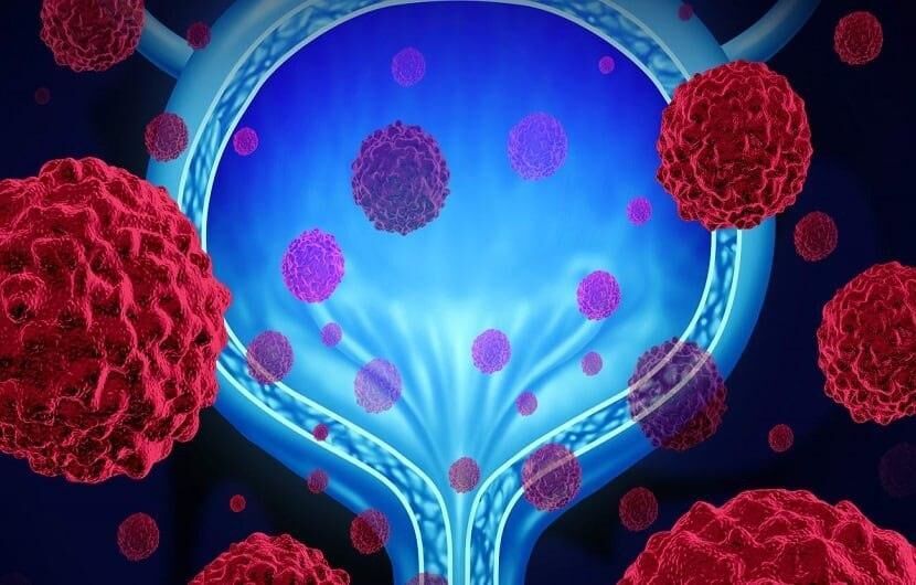 افزایش ابتلا به سرطان مثانه